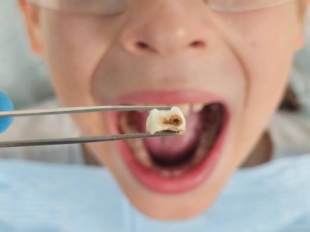 Best Emergency Wisdom Tooth Extraction in Goshen, KY
