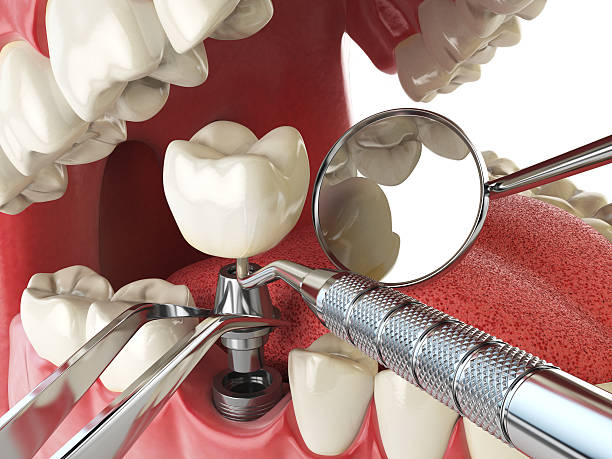 Best Emergency Wisdom Tooth Extraction in Goshen, KY